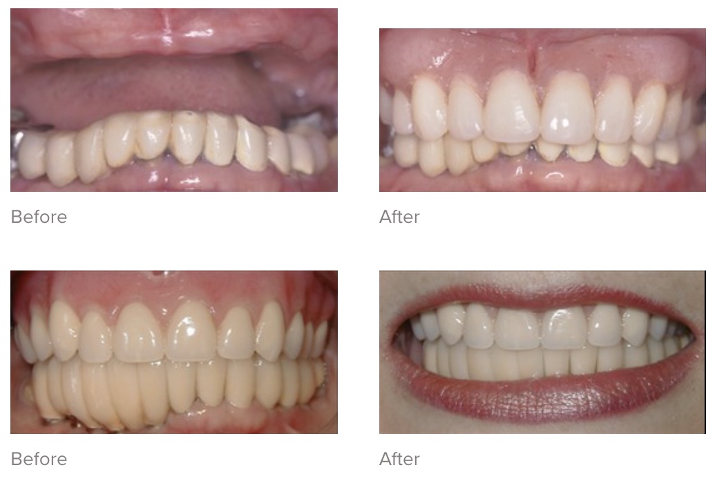 dentures and partials