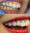 Crowns Veneers