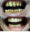 crowns/veneers-cosmetic dentistry