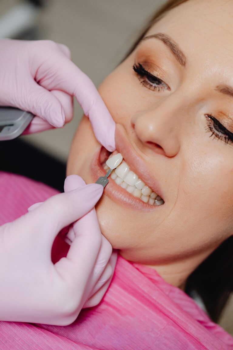 Porcelain Veneer