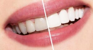 Professional Teeth Whitening