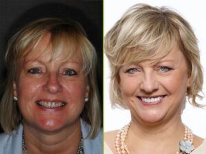 Smile Makeover Transformation