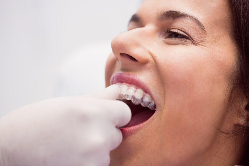Beverly Hills Invisalign