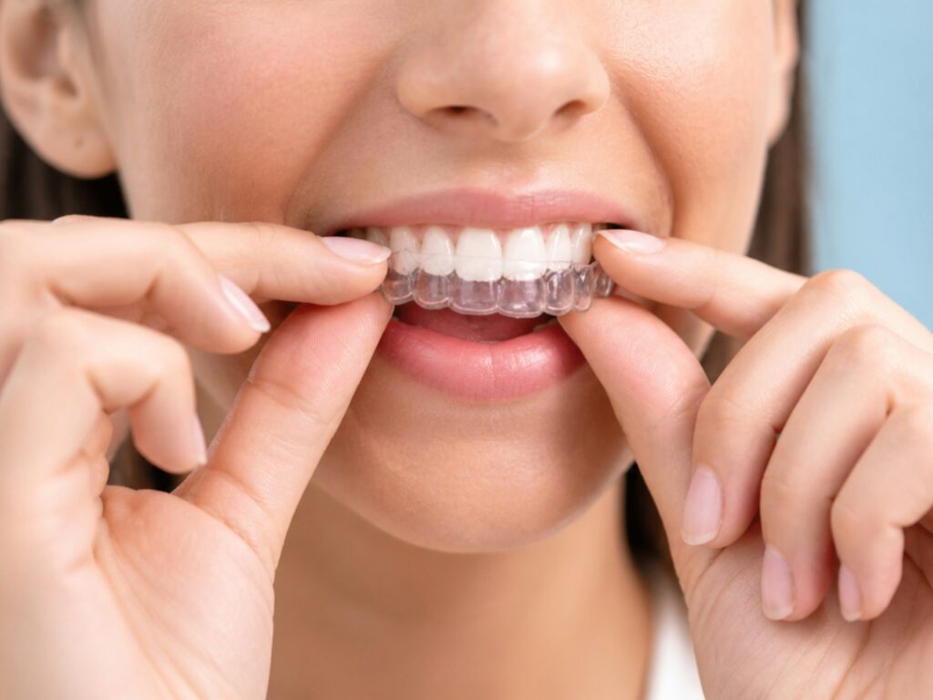 Beverly Hills Invisalign: Why Professionals Prefer Clear Aligners