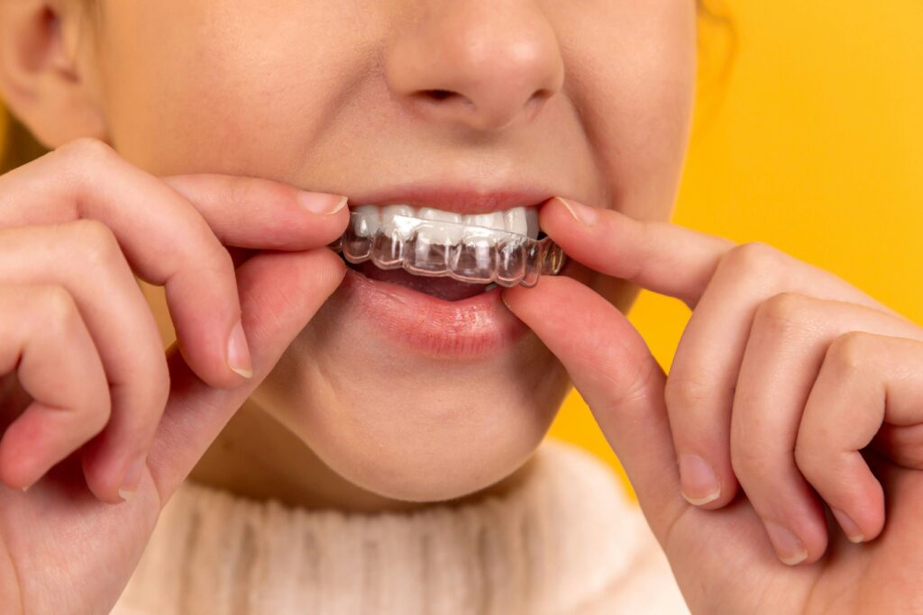 Invisalign in Beverly Hills: Treatment for Complex Cases
